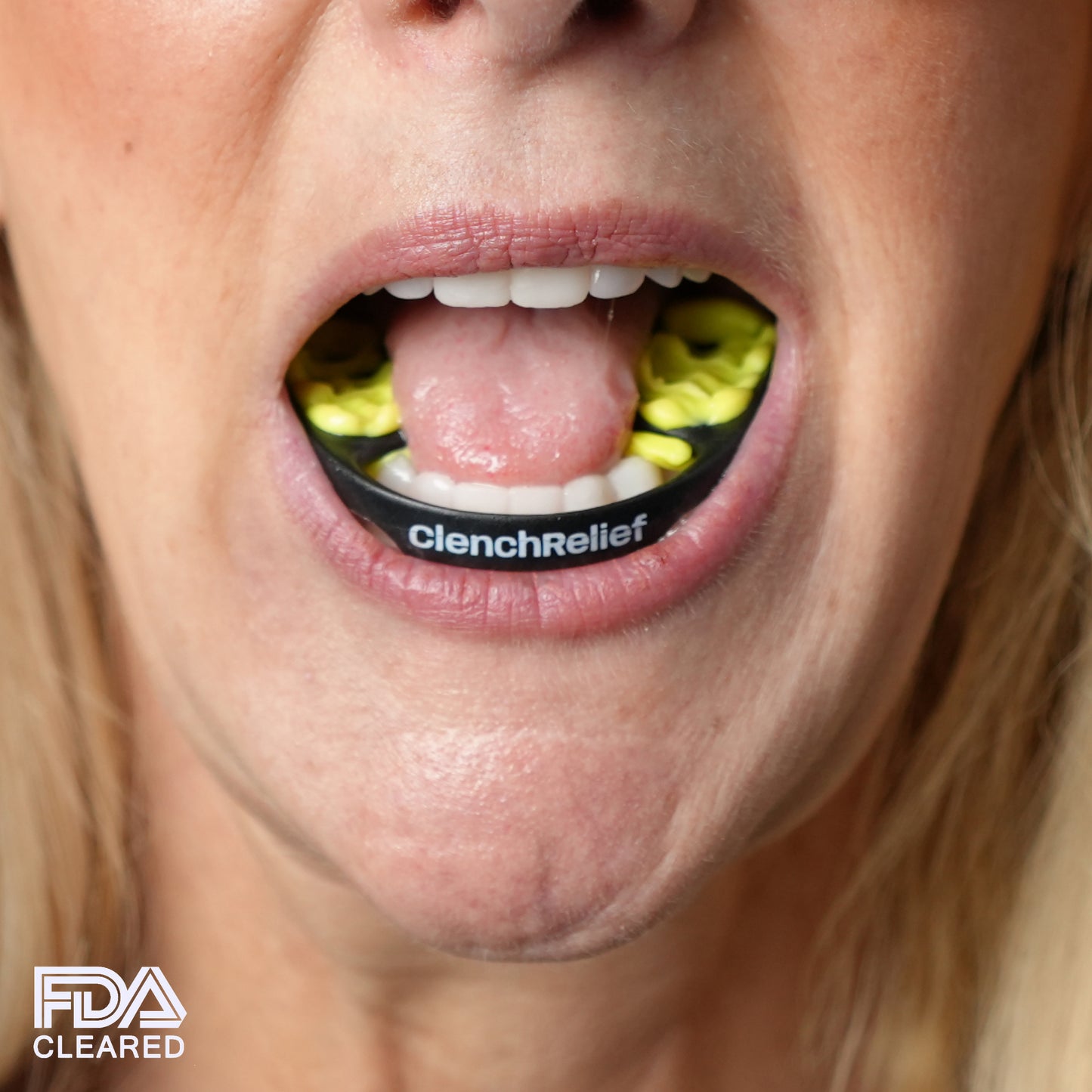 Patient wearing the CRI TMJ Mouthpiece with open mouth