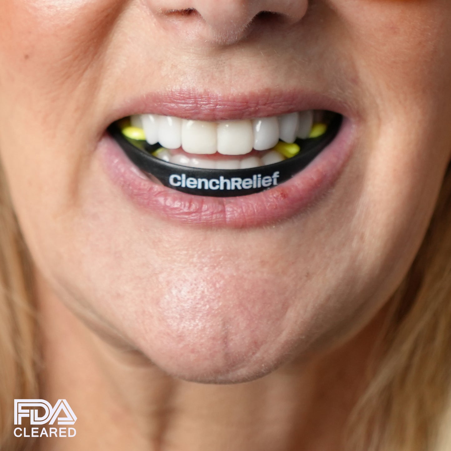 Patient wearing the CRI TMJ Mouthpiece with closed mouth