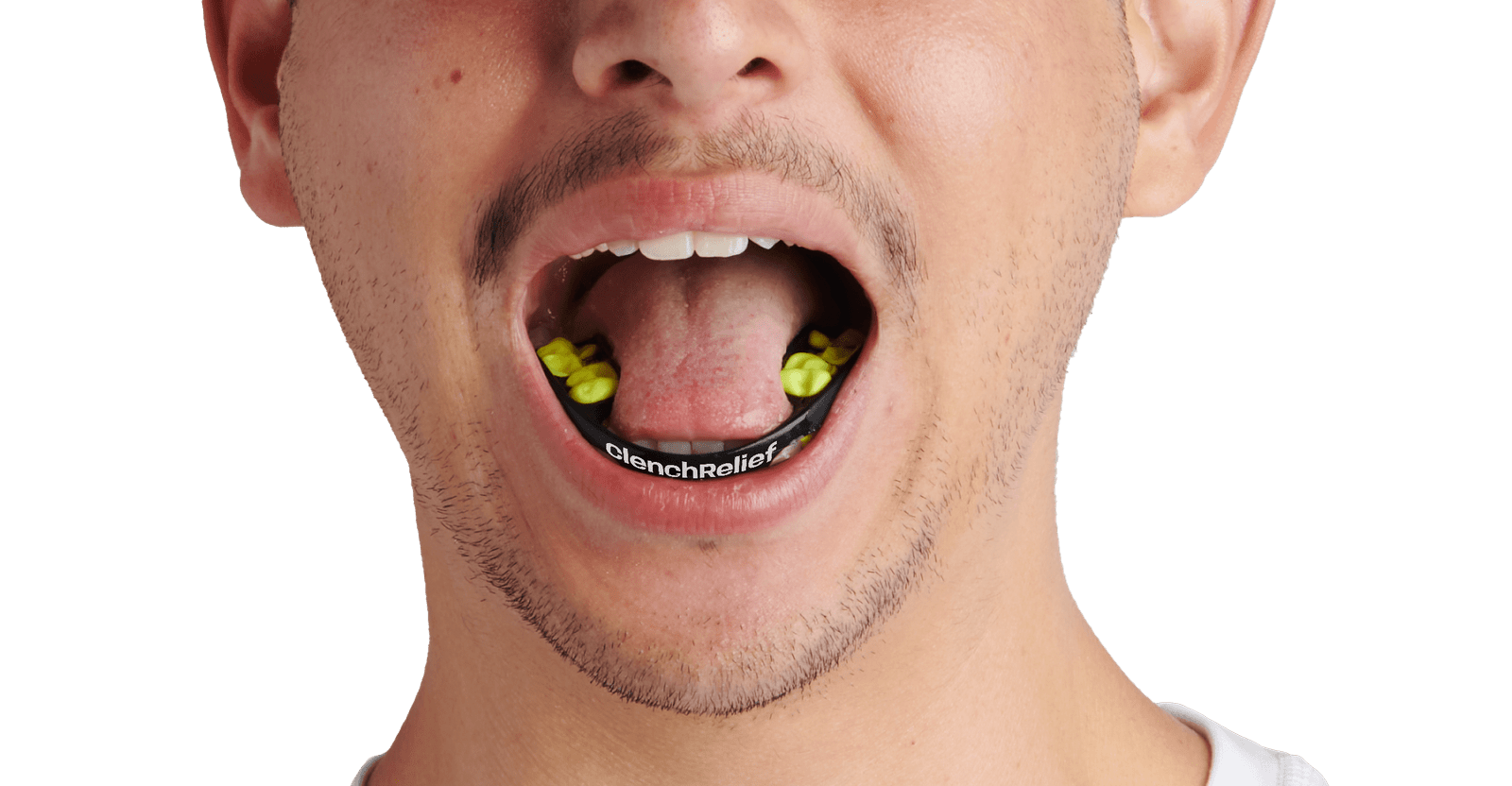 Patient wearing ClenchRelief mouthpiece